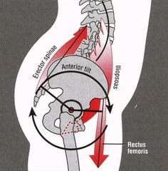 Lower crossed syndrome