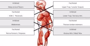 Upper and Lower Crossed Syndrome