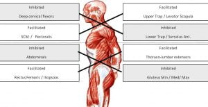 Upper and Lower Crossed Syndrome