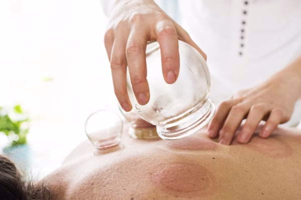 Cupping_Therapy